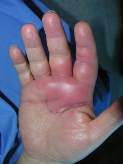 Animal Bite Cellulitis Photo
